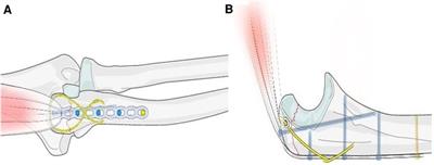 A novel internal fixation technique for the treatment of olecranon avulsion fracture